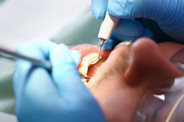 Best Emergency Treatment for Toothache in Butler, AL